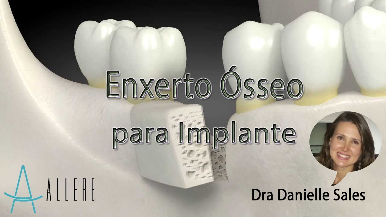 ENXERTO ÓSSEO PARA IMPLANTE -DRA DANIELLE SALES - www.clinicaallere.com.br