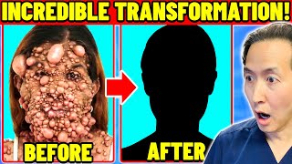 You Must See How She Looks Now! Plastic Surgeon Reacts To Extreme Neurofibromatosis