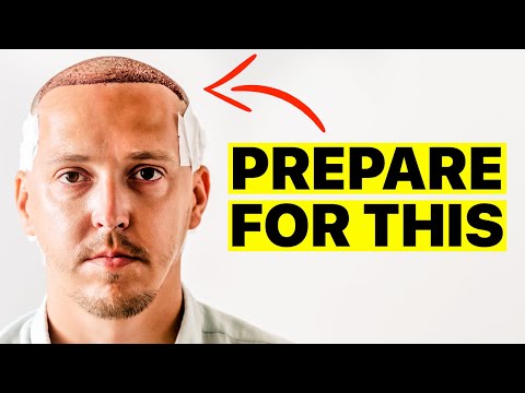 Hair Transplant - Everything You NEED To Know Before...