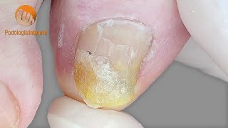 Toenail trimming & cleaning | I leave hallux nail long enough to avoid discomfort or sensitivity