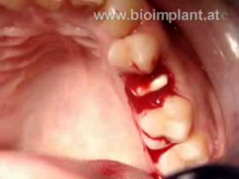 WORLD'S FIRST: IMMEDIATE ROOT-ANALOG ZIRCONIA DENTAL IMPLANT 3 MINUTES LIVE VIDEO