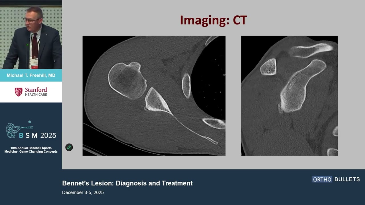 Bennetts Lesion Diagnosis and Treatment_Michael T. Freehill MD