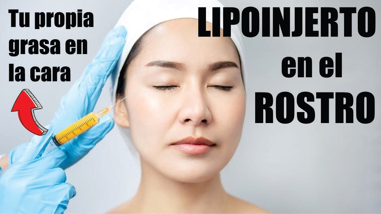 LIPOINJERTO en la CARA 💋 ROSTRO más BELLO con LIPOTRANSFERENCIA ❤️ Dr. PERCY NEVADO Cirugía Plástica