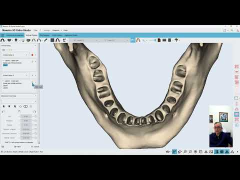 In-house Aligners and DIY solutions - Part 5
