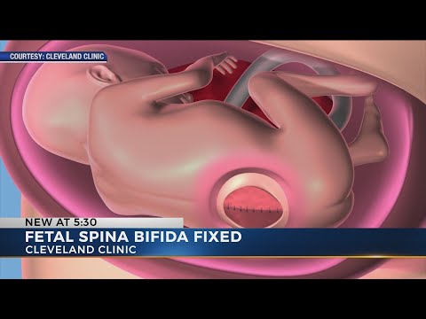 Cleveland Clinic performs its first in utero surgery on fetus, repairs spina bifida before baby’s bi