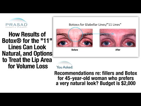 ボトックス、フィラー、PRPを使用した、おでこと唇のしわを自然に見せる治療法 (Natural-Looking Treatment for Wrinkles in Forehead and Lips Using Botox, Fillers, and PRP)