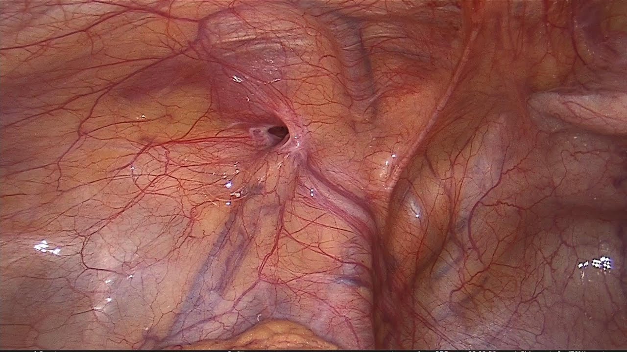 Orchidectomy TAPP