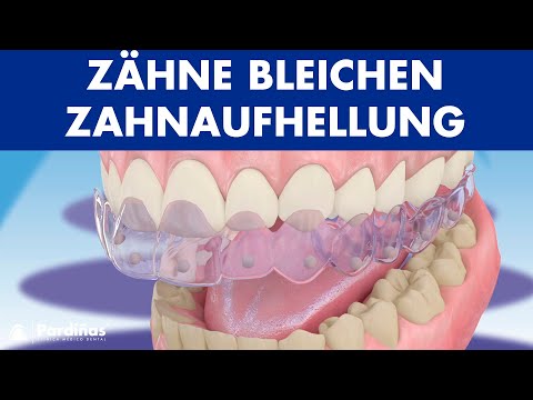Zähne bleichen – Zahnaufhellung ©