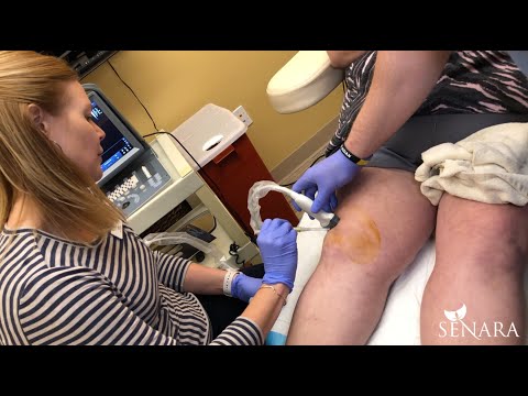 Watch a PRF Knee Injection at Senara