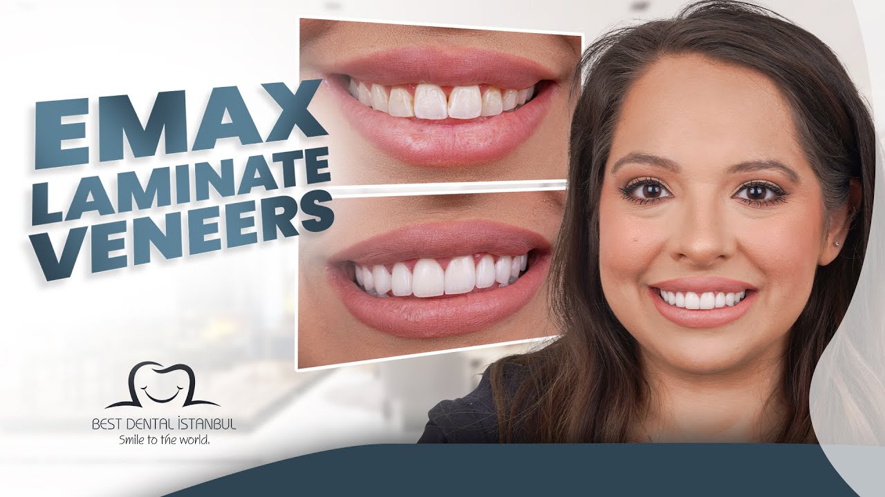 Perfect Smile with Emax Veneers"