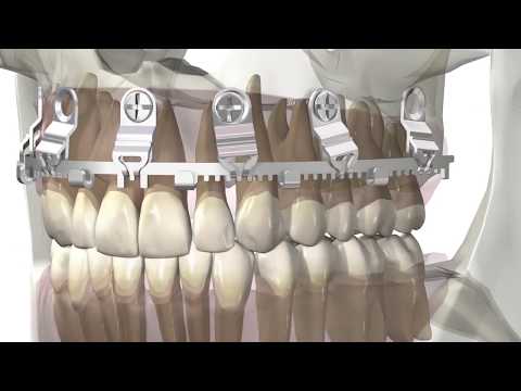 L1® MMF – "where strength and flexibility come together”