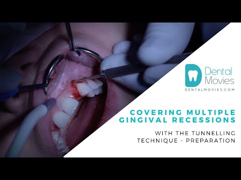 Covering multiple gingival recessions with the tunnelling technique - preparation