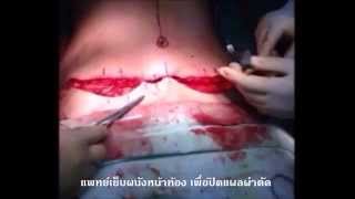 ผ่าตัดดึงหน้าท้องเพื่อแก้ไขรอยแตกลายและยกกระชับ ผ่าตัดดึงหน้าท้องเพื่อแก้ไขรอยแตกลายและยกกระชับ