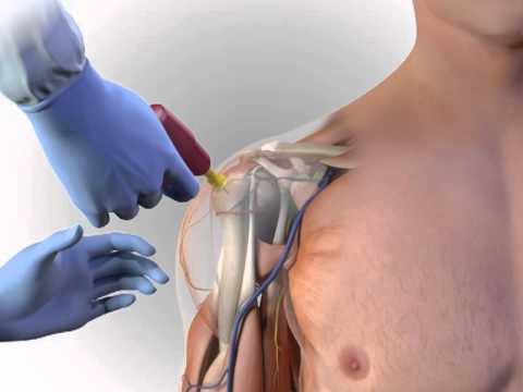Humerus Insertion EZ-IO - Official access method