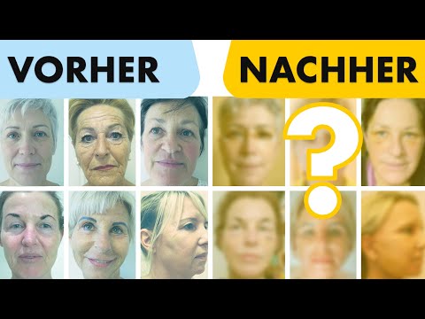 7 Facelifts 7 Tage nach OP offen gezeigt! Vorher & Nachher | Heilungsdauer | Dr. Jungwirth