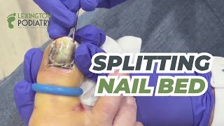 Bruised + Bloody Nail Removal