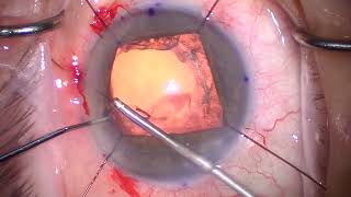 Download Lagu Complicated Cataract surgery. 1 piece IOL in sulcus UGH replaced for optic captured 3 piece Thumbnail