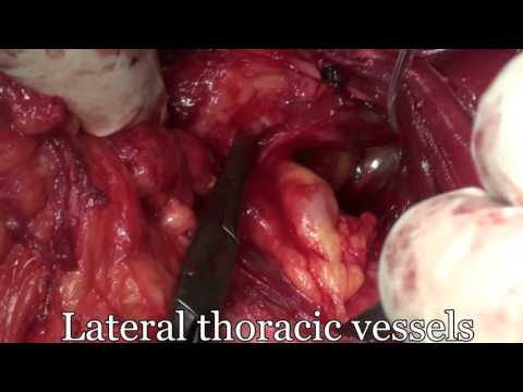 Modified Radical Mastectomy Final