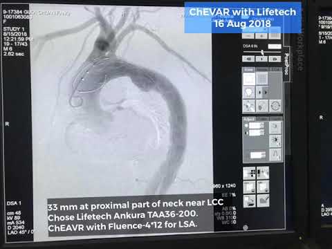 ChEVAR with Lifetech Ankura 16 Aug 2018