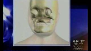 Dr. Antell explains the full face transplant