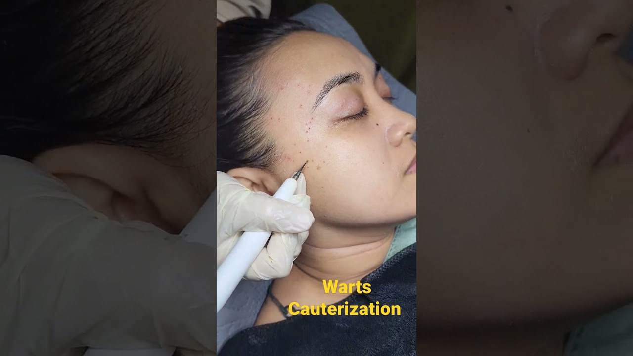 Warts Cauterization  #warts  #health #wartstreatment #face #beauty