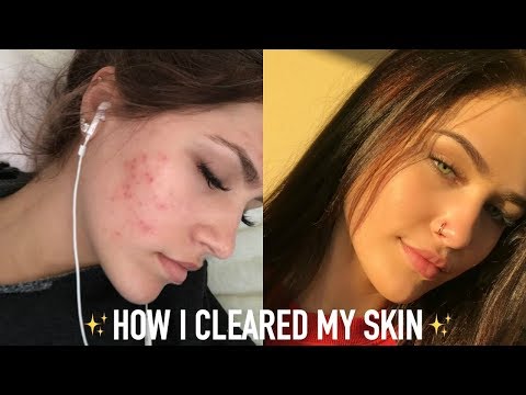 MY SKINCARE ROUTINE! (HOW I CLEARED MY ACNE) | Mel Joy