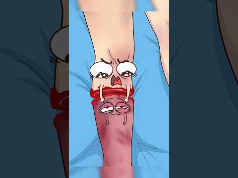 🦵 Mon pied me parle encore ! Comprendre la douleur fantôme