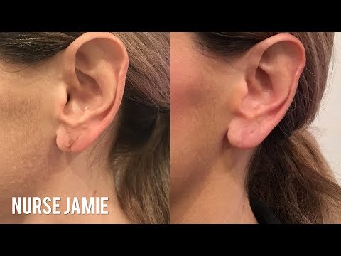 Incredible Lobe Lift - Nurse Jamie - ExtraTV