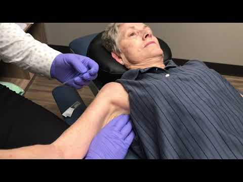 乾式針治療による凍結肩の治療 (Treating Frozen Shoulder With Dry Needling)