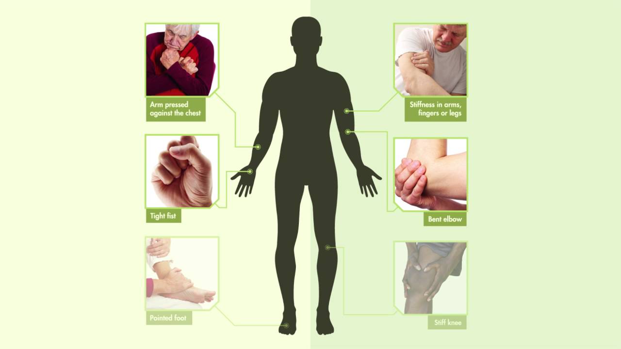 Spasticity Informational Video