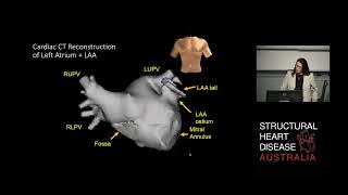 Left Atrial Appendage “Non” Closure – Dr Julie Humphries