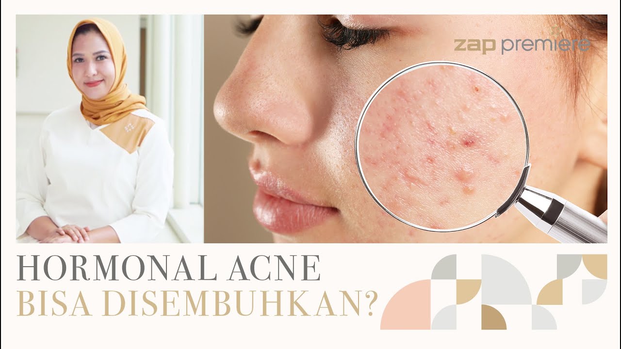 Penyebab Hormonal Acne dan Cara Mengatasinya.