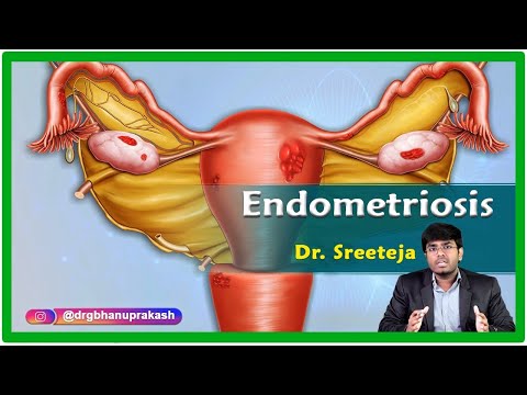 Endometriosis : Causes, Signs and symptoms, Pathophysiology, Diagnosis and Treatment / Gynecology