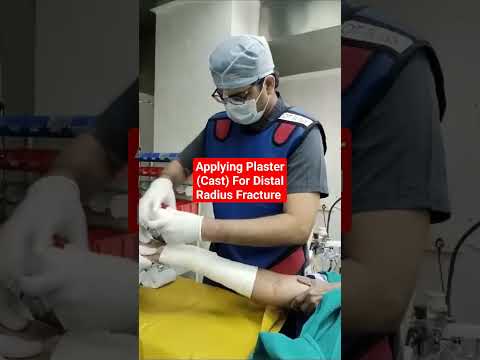 Applying Plaster (Cast) Distal Radius Fracture...Dr Sai Chandra..Knee n Shoulder Surgeon Hyderabad