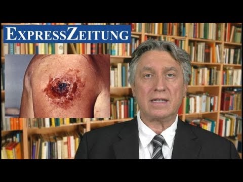Was ist feuchtes Ekzem Die Cremes von der Schuppenflechte in almaty