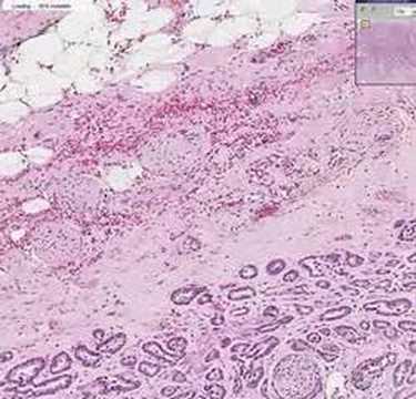 Ultraschall-Prostata Smolensk Wie ein Katheter in der Blase nach einem Prostata-Operation zu ändern,