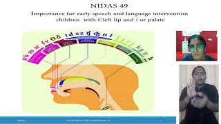Importance for early speech and language intervention in children  with Cleft lip and / or palate
