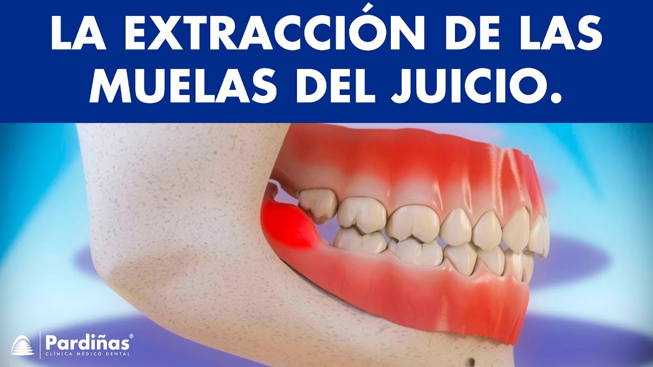 Extracción de muelas del juicio y pericoronatis - ¿Por qué se extraen las cordales ©