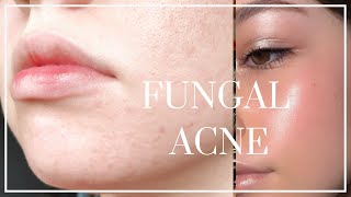 How to Get Rid of Fungal Acne // BEAT TINY BUMPS