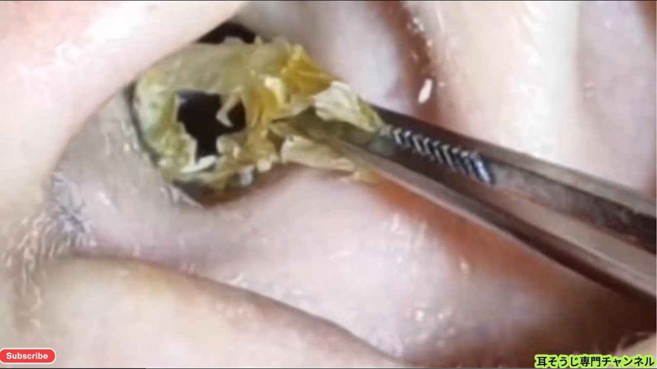 🎧 耳かき耳掃除 |深い耳垢の除去とリラックス #231