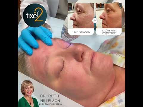 Tixel Treatment Gone Wrong