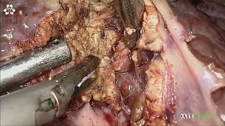 Asvide: Fluorescence-guided laparoscopic resection of segment 4 plus the right anterior ventral...