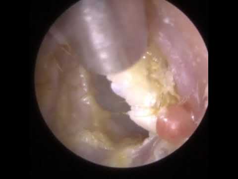 817 - Grade III Keratosis Obturans & Tympanosclerosis Ear Wax Removal