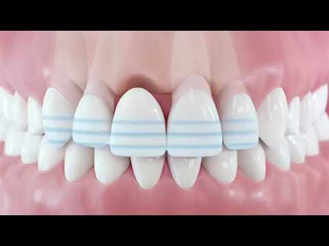Dental Procedure Animation