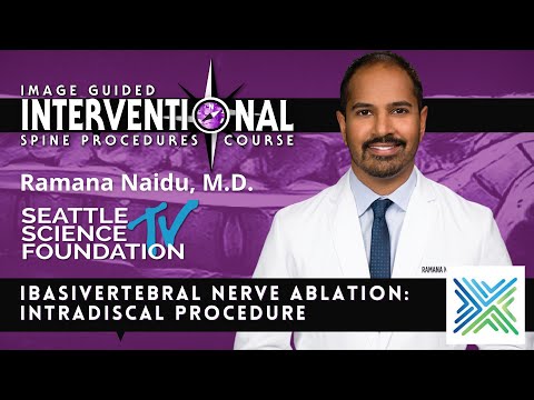 Basivertebral Nerve Ablation  Intradiscal Procedure - Ramana Naidu, M.D.
