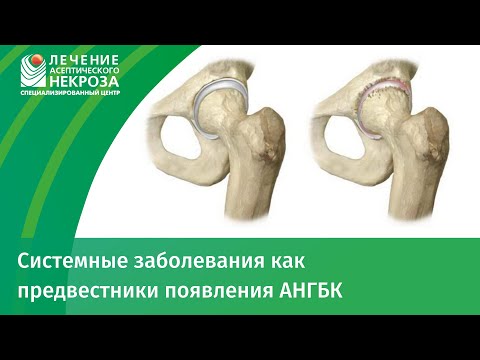 Артроз голеностопного сустава положена ли группа инвалидности Осложнения после артроскопии коленного сустава