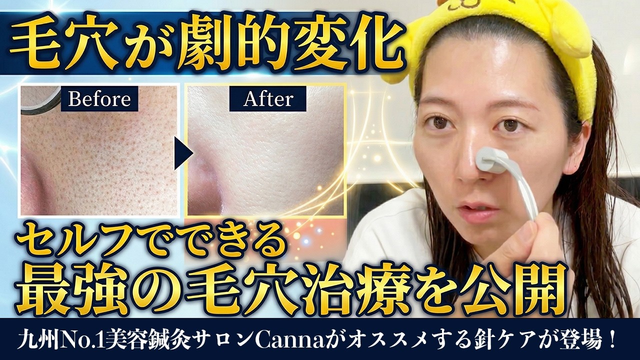 【毛穴消滅】浸透率1000%超え!? ダーマローラーの劇的効果と失敗しないセルフケア術