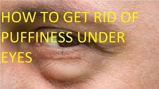 how to get rid of puffiness under eyes home remedies