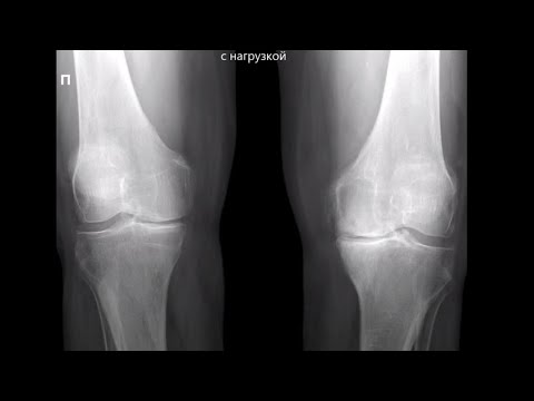 Рентгенография коленного сустава с нагрузкой