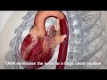 About Transcatheter Aortic Valve Replacement TAVR
